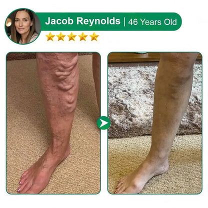 🦵🦵🦵Clearena® VeinTarget Microneedle Patch —— Once Daily, Visible Results in 7 Days