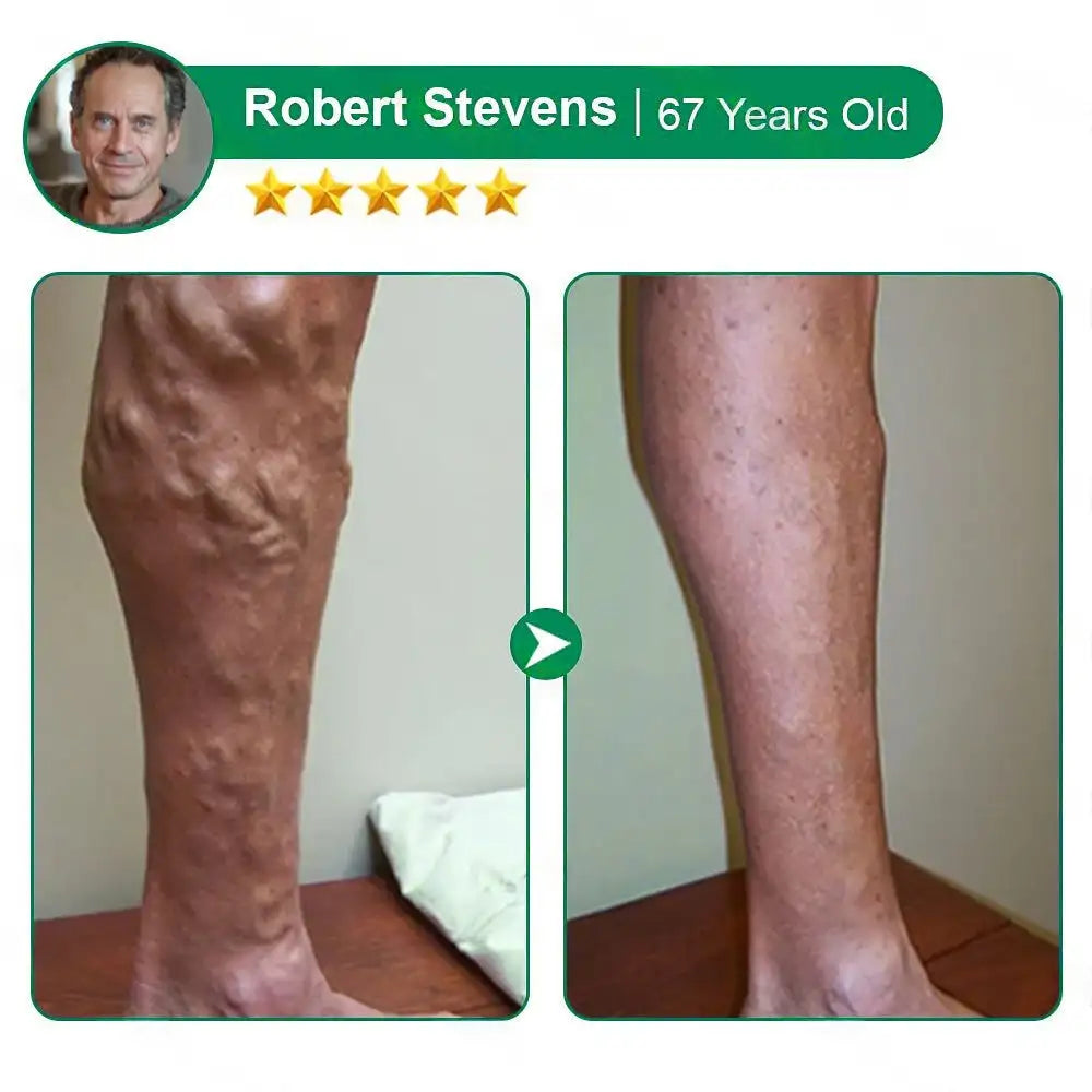 🦵🦵🦵Clearena® VeinTarget Microneedle Patch —— Once Daily, Visible Results in 7 Days